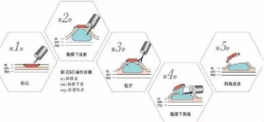 ESDg(sh)ʽ