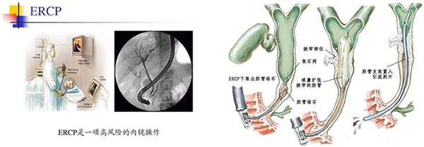 ERCP